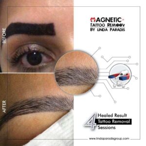 , Magnetic Tattoo Removal &#8211; A Fast, Safe Solution for Tattoo &#038; Permanent Makeup Issues