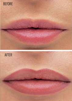 Lip Pigmentation, Lip Pigmentation &#038; Permanent Lipstick